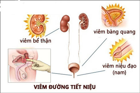 viêm đường tiết niệu nam giới