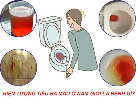 đái ra máu chữa ở đâu Bắc Giang