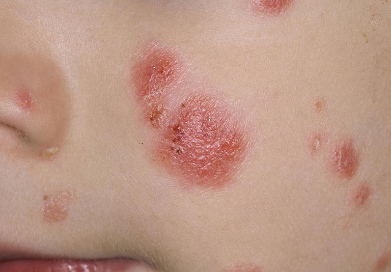 Bệnh vảy nến ở trẻ em