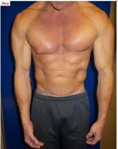 Gyno-in-right-nipple-Jay-Campbell-TRT-Revolution