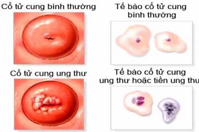 Ung thư cổ tử cung