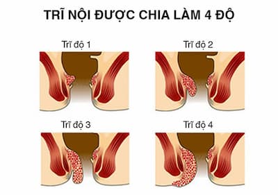 Các cấp độ của bệnh trĩ nội