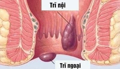 Bệnh trĩ là gì