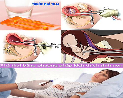 đình chỉ thai nghén