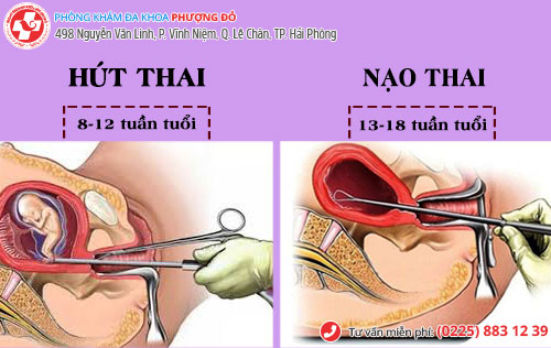 đình chỉ thai 18 tuần tuổi