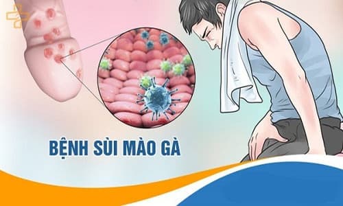 bệnh sùi mào gà