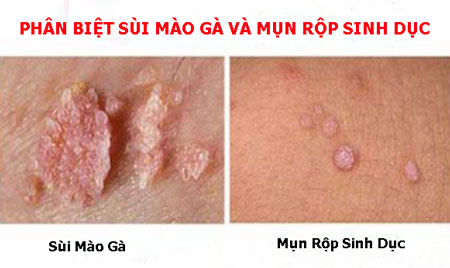 bệnh sùi mào gà