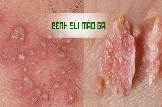 bệnh sùi mào gà