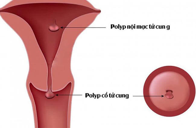 polyp cổ tử cung là gì