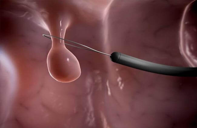Điều trị polyp cổ tử cung