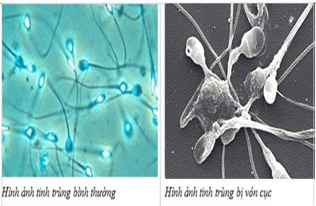 tinh trùng vón cục