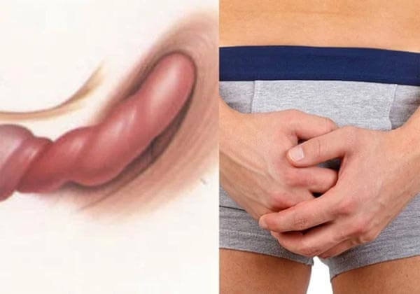 đau tinh hoàn là bệnh gì