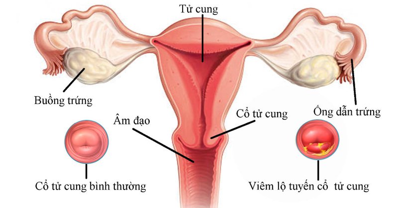 Viêm lộ tuyến cổ tử cung là gì?