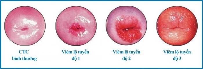 Điều trị viêm lộ tuyến cổ tử cung 