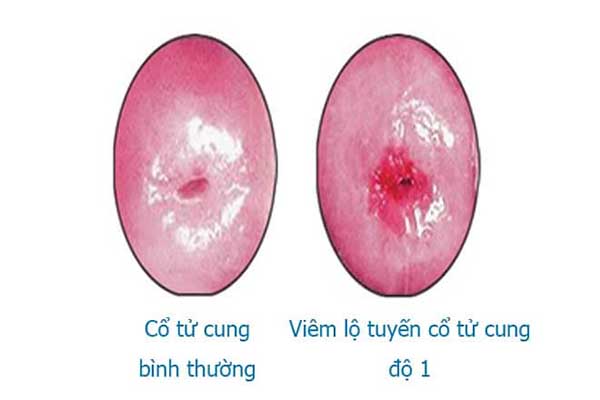 Tìm hiểu viêm lộ tuyến cổ tử cung