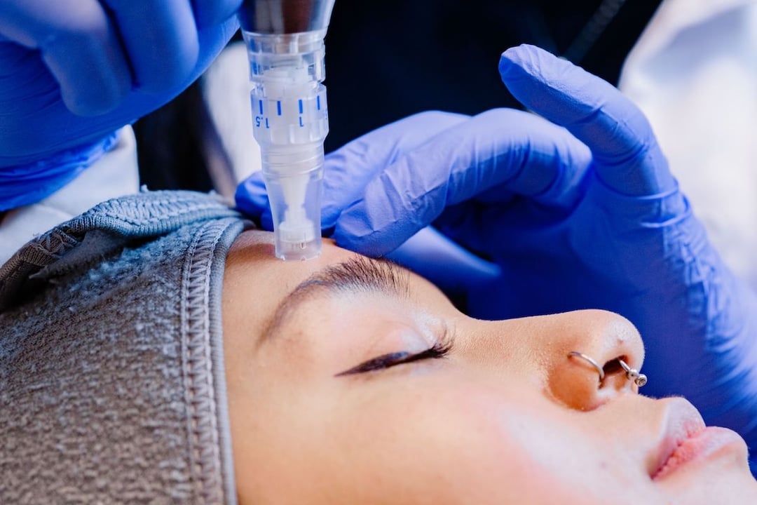 SkinPen® Microneedling in Dublin, OH Solutions IV Boutique & MediSpa