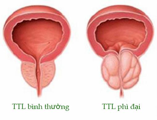 Bệnh phì đại tiền liệt tuyến hay u xơ tiền liệt tuyến