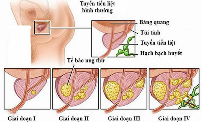 Bệnh ung thư tiền liệt tuyến