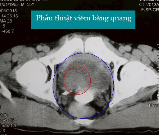 Phẫu thuật viêm bàng quang đối với những trường hợp u, sỏi bàng quang