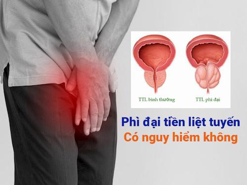 Bệnh phì đại tiền liệt tuyến cần phát hiện và chữa trị kịp thời để tránh nguy hiểm sau này