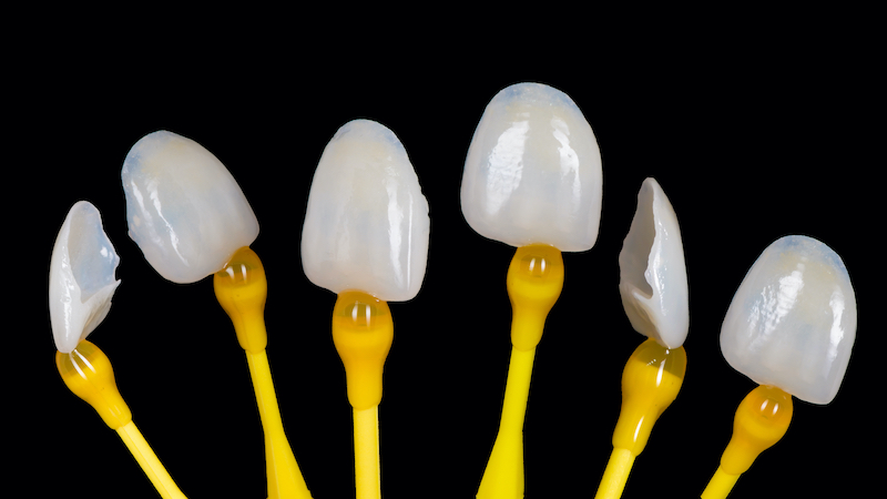 dental-veneers-intellidentsia