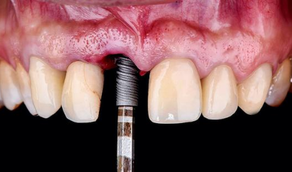 dental-implants-intellidentsia