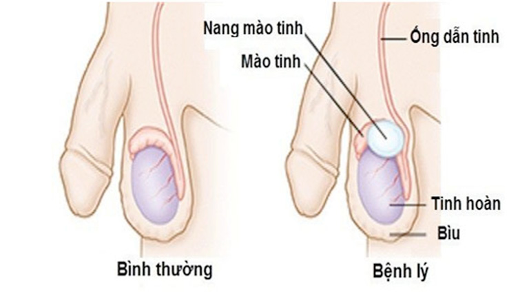 các bệnh nam khoa thường gặp