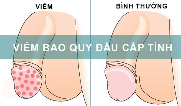 các bệnh nam khoa thường gặp