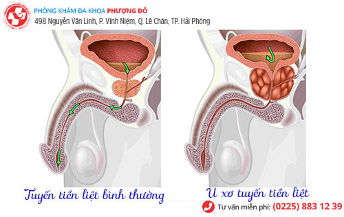 Tuyến tiền liệt là gì? Vị trí - Cấu tạo - Chức năng - Bệnh thường gặp?