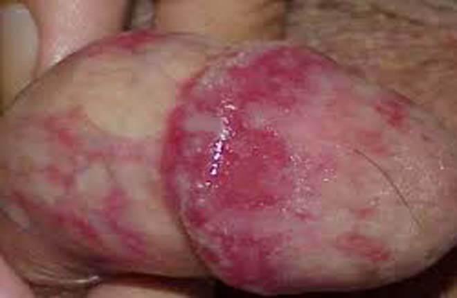 địa chỉ chữa sưng bao quy đầu