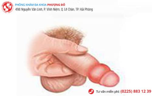 địa chỉ chữa sưng bao quy đầu
