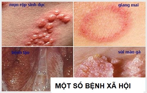 bệnh về dương vật