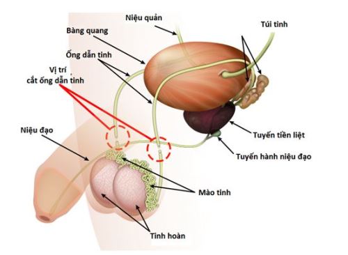 thắt ống dẫn tinh bao nhiều tiền