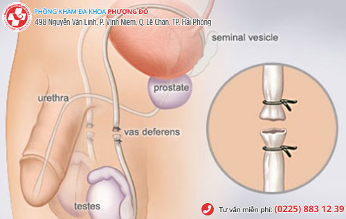 thắt ống dẫn tinh bao nhiều tiền