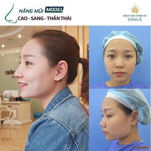 Nâng mũi sụn tự thân có vĩnh viễn không? Cách sửa nào tốt nhất? Hình 5