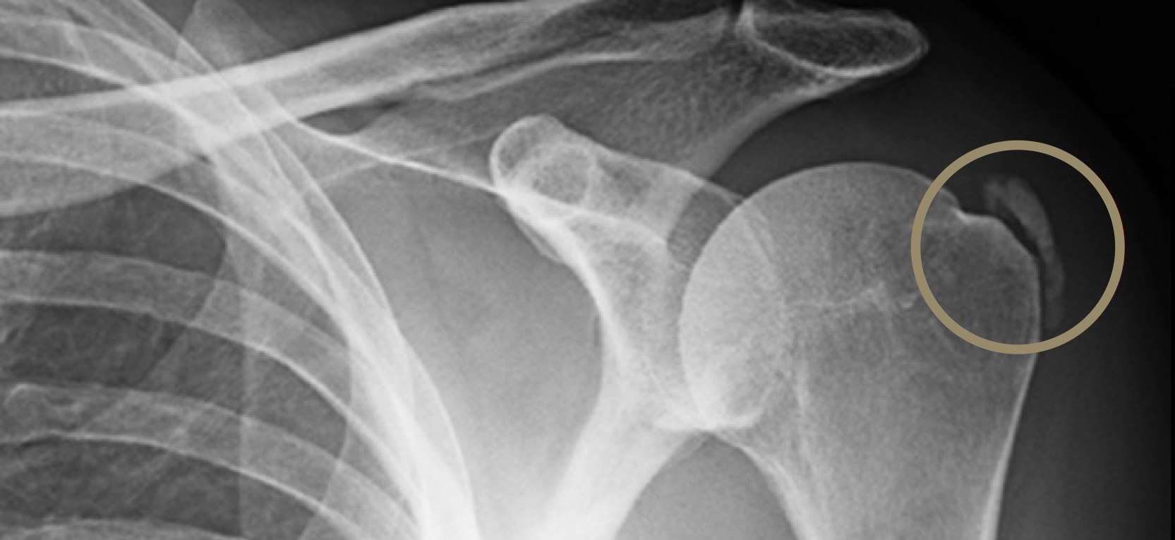 Calcification de l'épaule Chirurgie de l'épaule