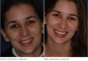 Braces for Adults