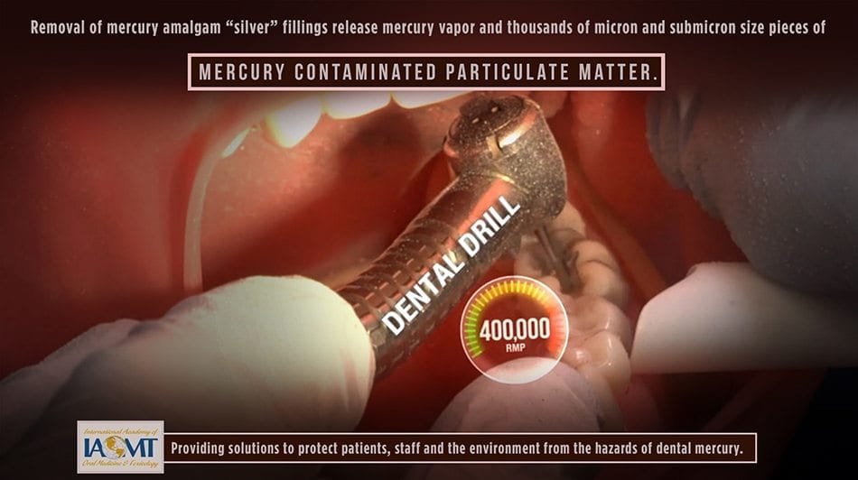 Amalgam removal creates mercury vapor and particulate matter