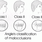 Malocclusions
