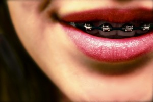 Indianapolis Braces