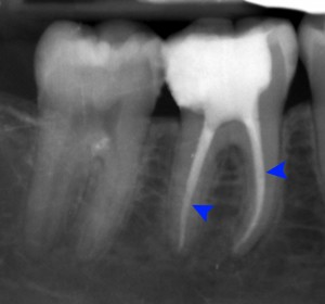 Affordable Root Canals in Indianapolis