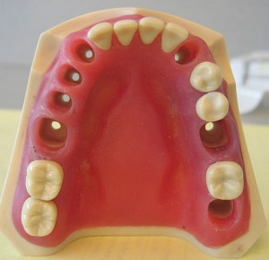 Best Tooth Replacement Options