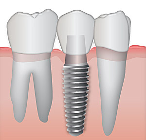 Digital View of Dental Implants