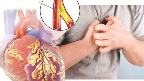 Tăng huyết áp, suy tim, tâm phế mạn dễ gặp trong mùa đông