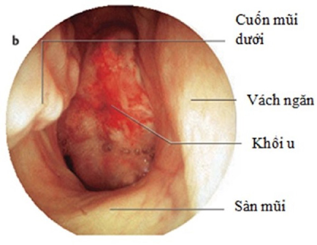 Hình ảnh khối u vòm họng