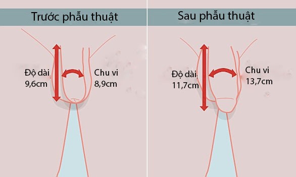 “Trình làng” kỹ thuật tăng kích thước “cậu nhỏ” đơn giản đến ngạc nhiên - 2