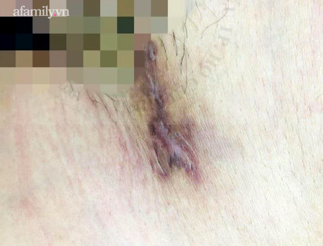 Quan hệ tình dục với nhiều bạn tình, nam thanh niên 28 tuổi nhiễm cùng lúc giang mai và căn bệnh hột xoài hiếm gặp - 2