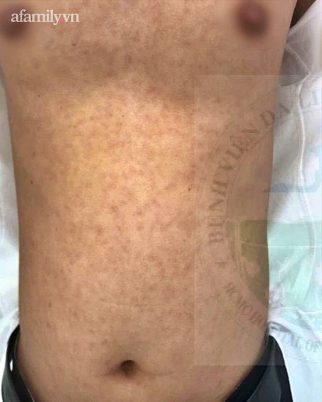 Quan hệ tình dục với nhiều bạn tình, nam thanh niên 28 tuổi nhiễm cùng lúc giang mai và căn bệnh hột xoài hiếm gặp