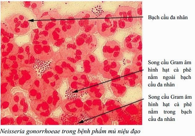 Nhiều nam giới mắc bệnh lậu, bác sĩ chỉ rõ thủ phạm - 1