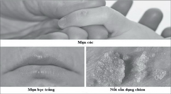 Tình dục bằng miệng, coi chừng lây bệnh